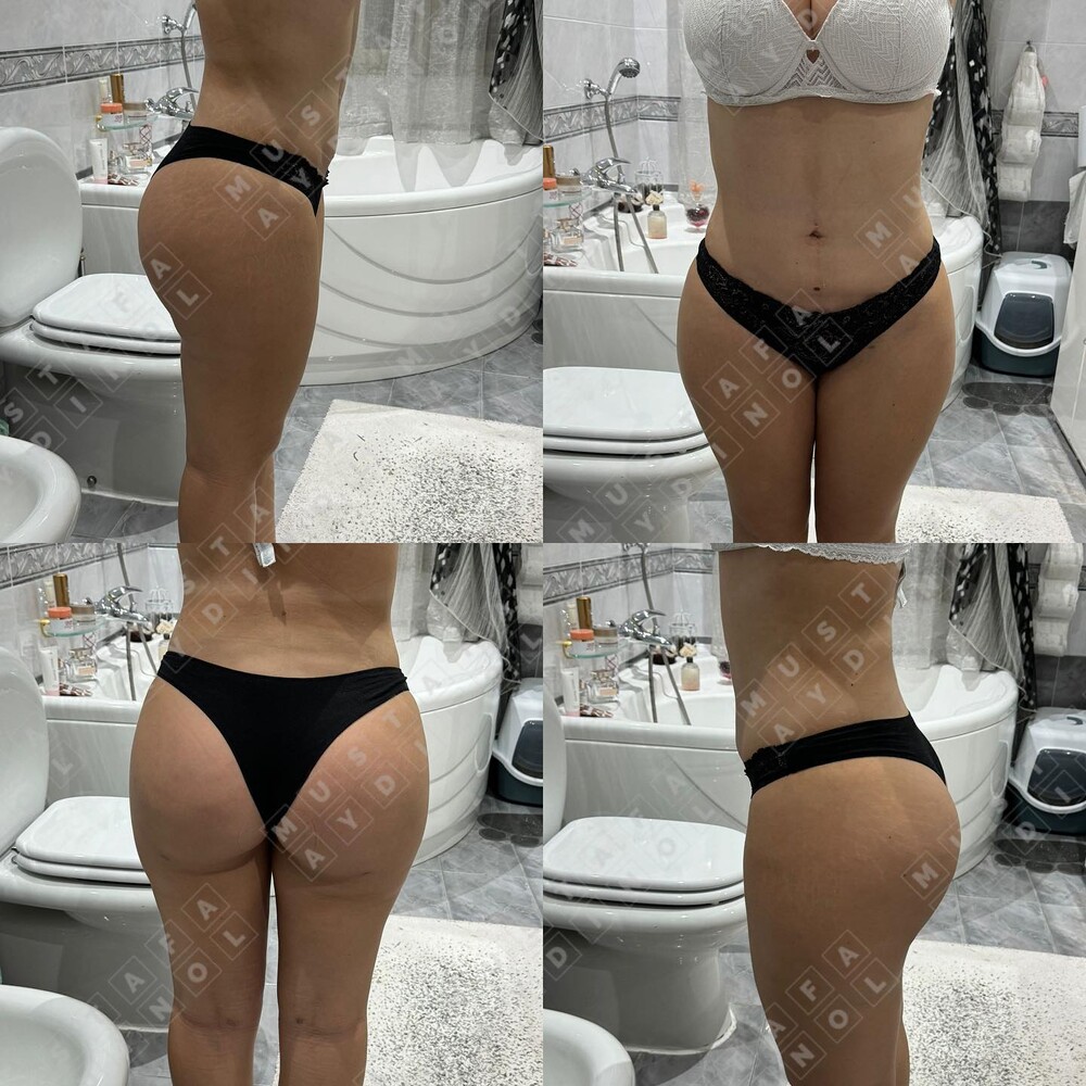 Before and After Result